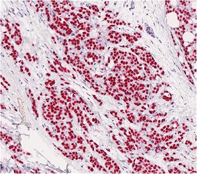 Methylation Profile of X-Chromosome–Related Genes in Male Breast Cancer